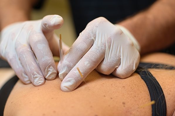 Dry Needling - Heinen Physical Therapy - Oklahoma City OK