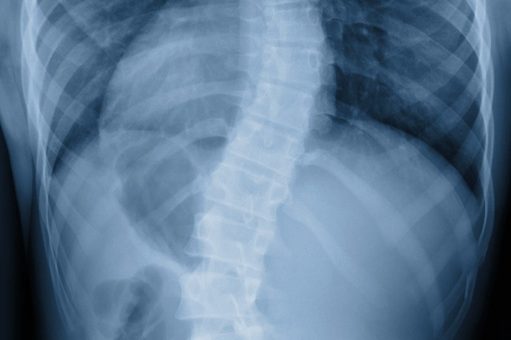 Scoliosis film x-ray show spinal bend in teenager patient