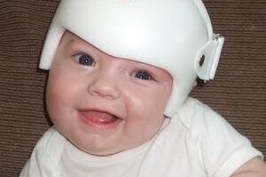 torticollis torticollis