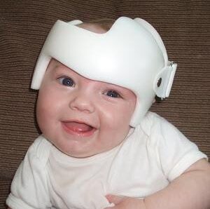 torticollis torticollis