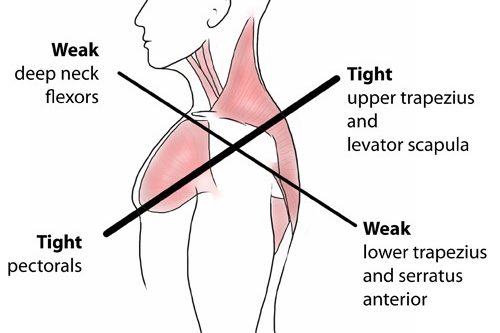 uppercrosssyndrome