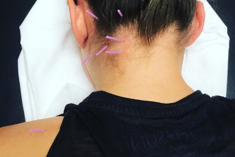 dry needling dry needling