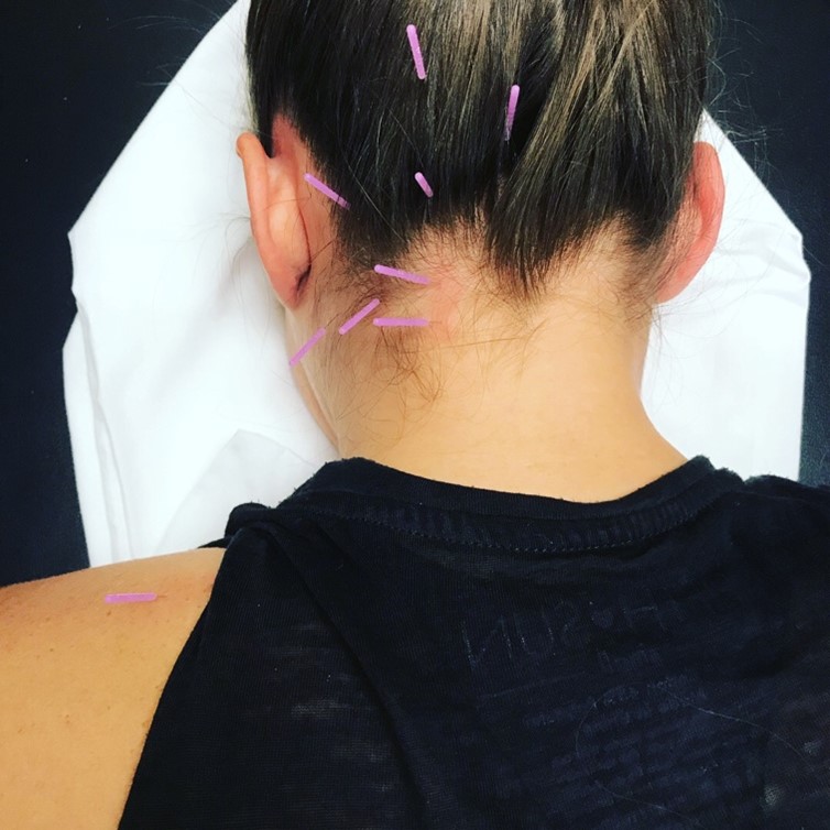 Can Dry Needling Help My Headaches? Arizona Orthopedic Physical Therapy