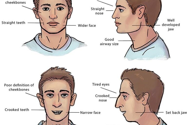 omdFace orofacial myofunctional disorder