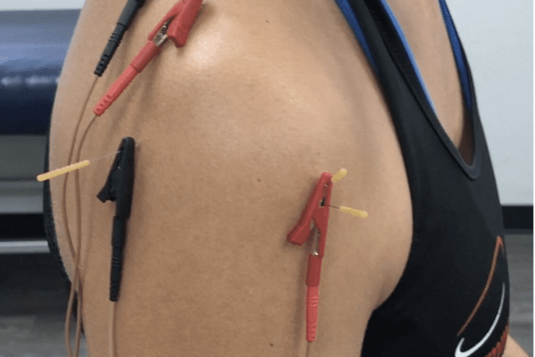 dry needling for shoulder pain