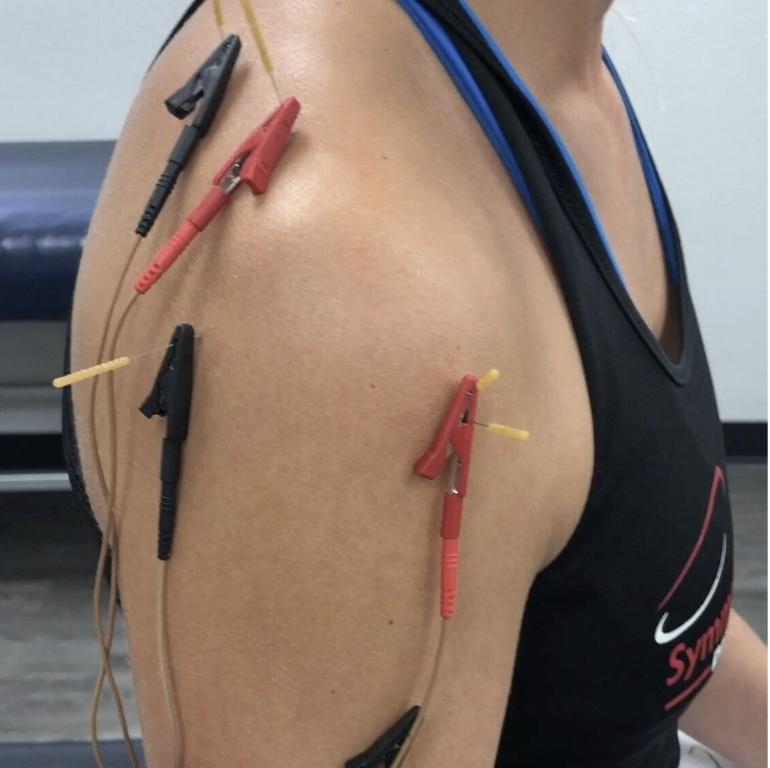dry needling for shoulder pain